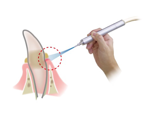 プラズマ治療前
